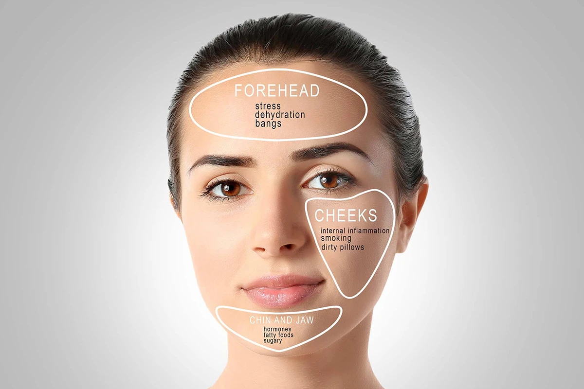 علت جوش زدن صورت چیست؟