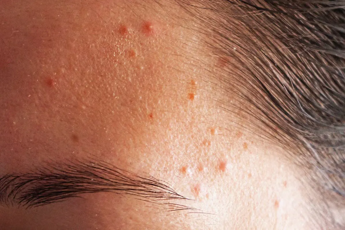 علت جوش پیشانی